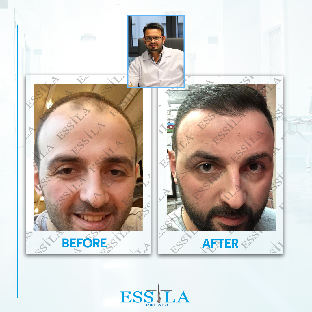 Essila Hair Transplant – Essila Hair Center is one of the best hair  transplant clinic in Turkey
